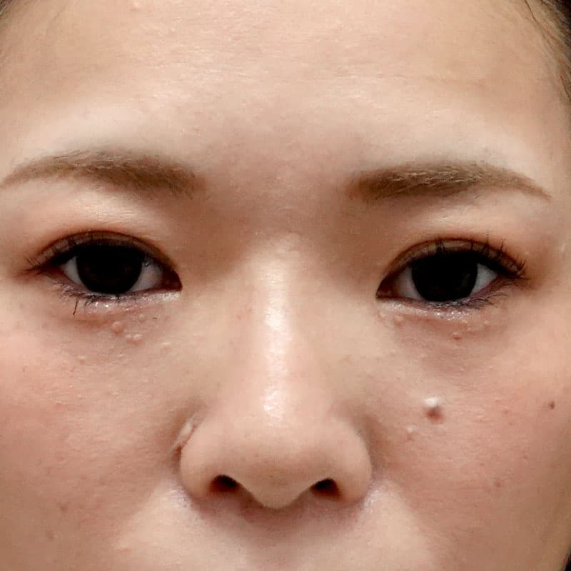 20260804_H169285_hosono_hyaluronic nose①After