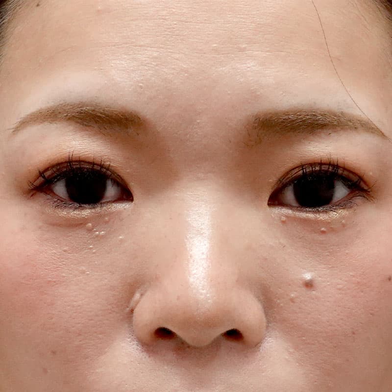 20260804_H169285_hosono_hyaluronic nose①Before