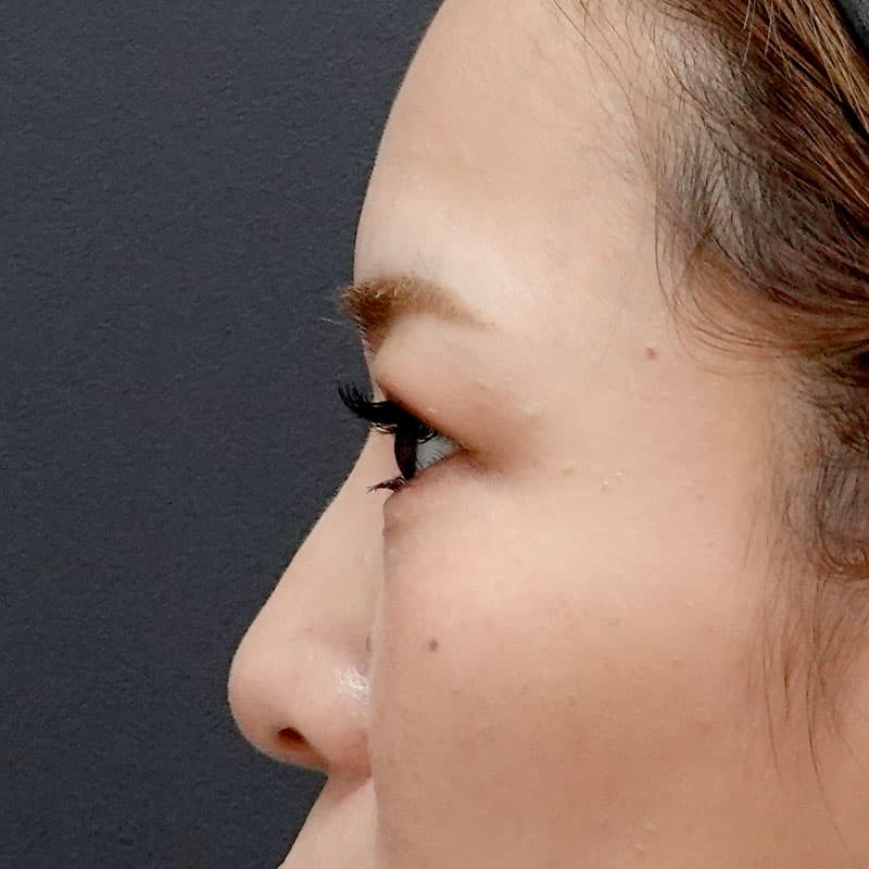20260804_H169285_hosono_hyaluronic nose②After