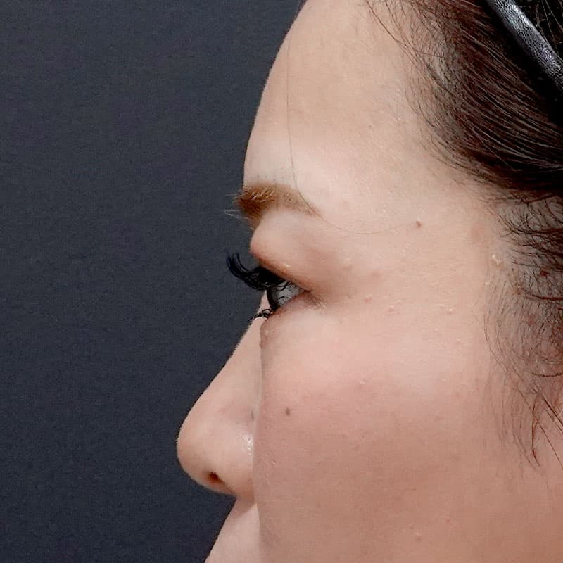 20260804_H169285_hosono_hyaluronic nose②Before