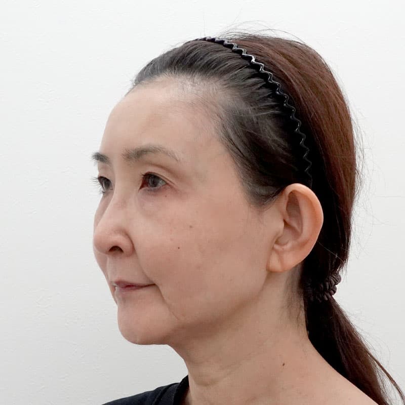 20260810_F116944_nagahama_hyaluronic acid lift①Before