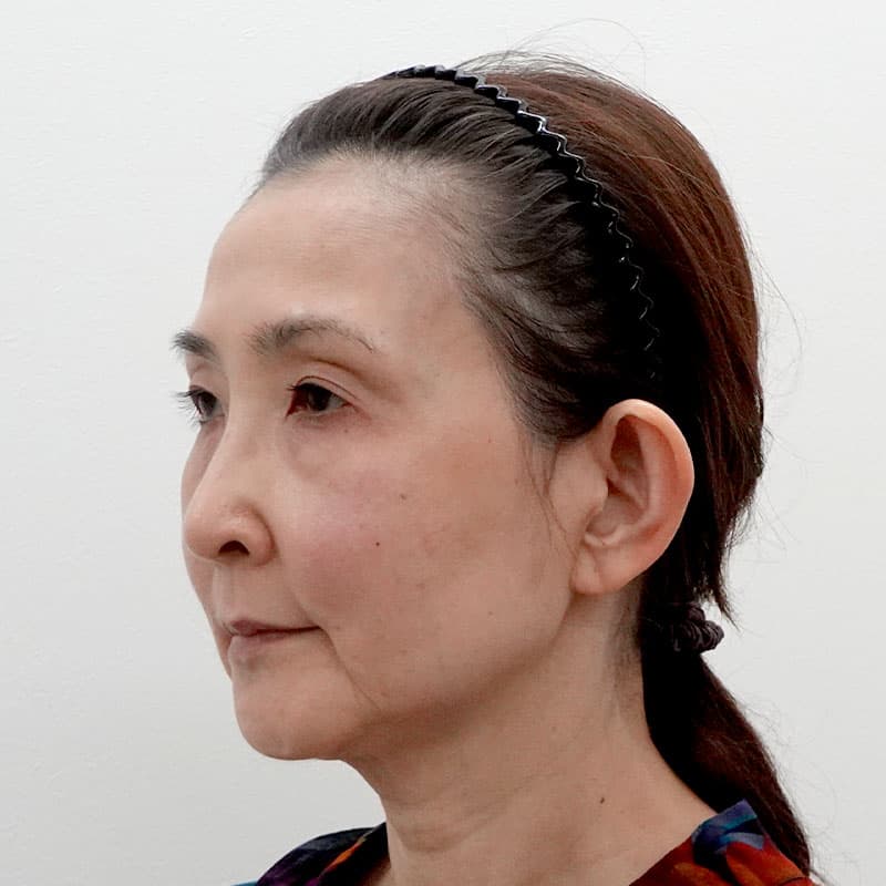 20260810_F116944_nagahama_hyaluronic acid lift①Before