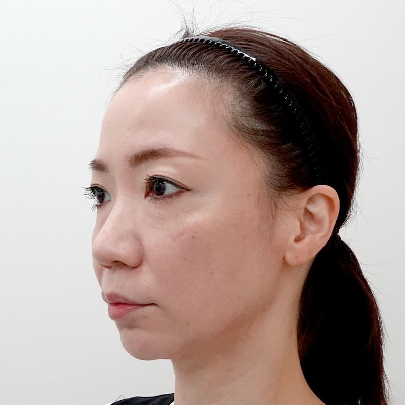 20260810_F751_kadoya_hyaluronic acid lift①After