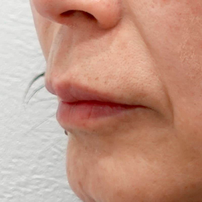 20260812_G32771_ota_hyaluronic lips①After (1)