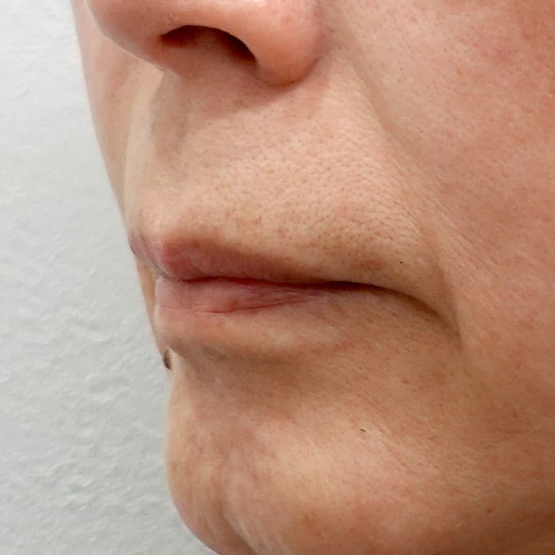 20260812_G32771_ota_hyaluronic lips①Before