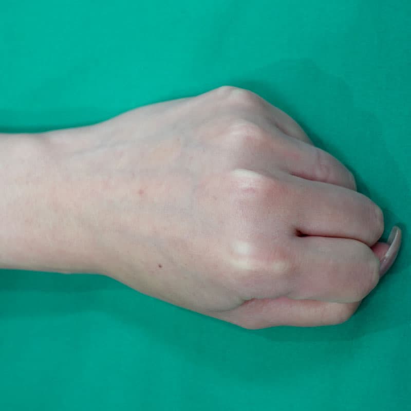 20260812_St20260812-5_ota_hyaluronic back of the hand①After