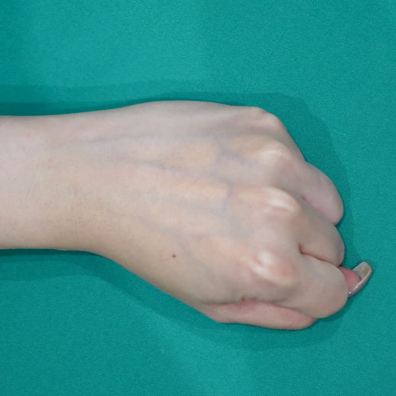 20260812_St20260812-5_ota_hyaluronic back of the hand①Before