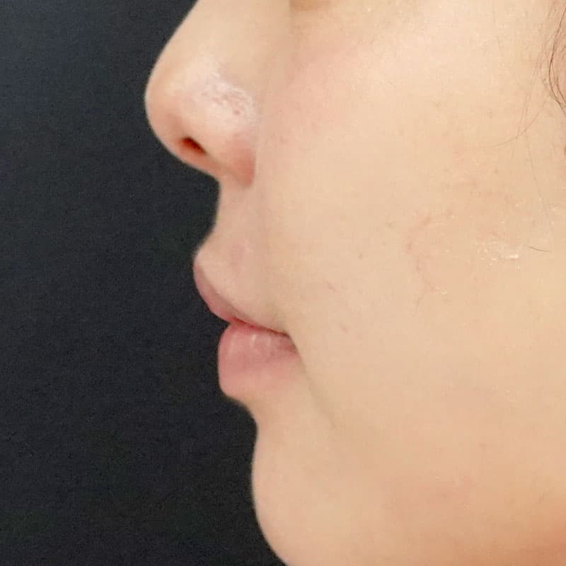 20260813_St20260813-4_ota_philtrum-botox①After