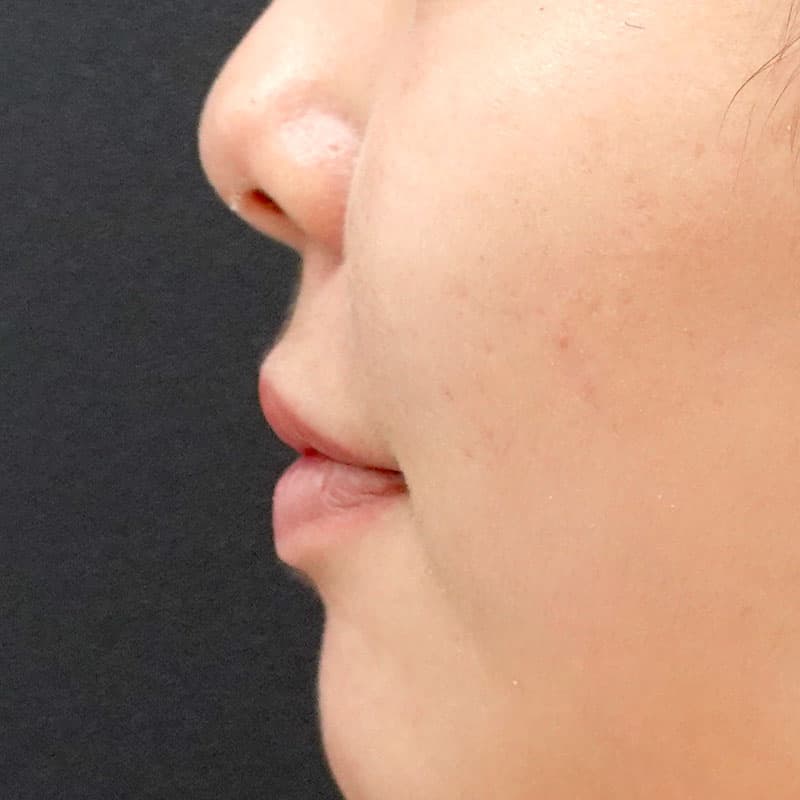 20260813_St20260813-4_ota_philtrum-botox①Before
