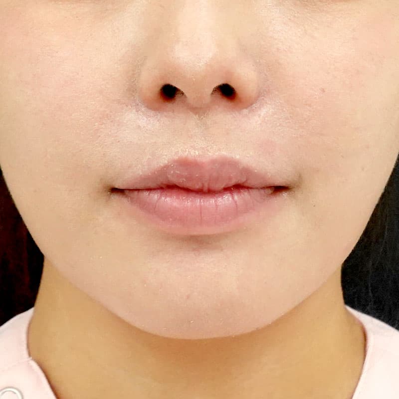 20260813_St20260813-4_ota_philtrum-botox②After