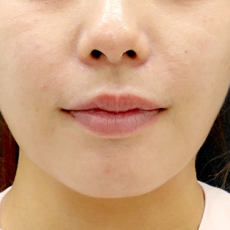 20260813_St20260813-4_ota_philtrum-botox②Before