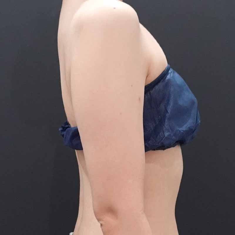 20260815_F100927_nagahama_arm-liposuction①Before