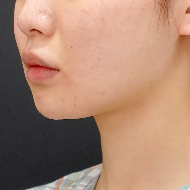 20260817_N151075_nishikawa_face-liposuction_masseter-muscle-botox①After