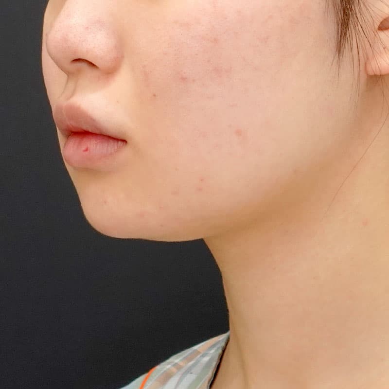 20260817_N151075_nishikawa_face-liposuction_masseter-muscle-botox①Before