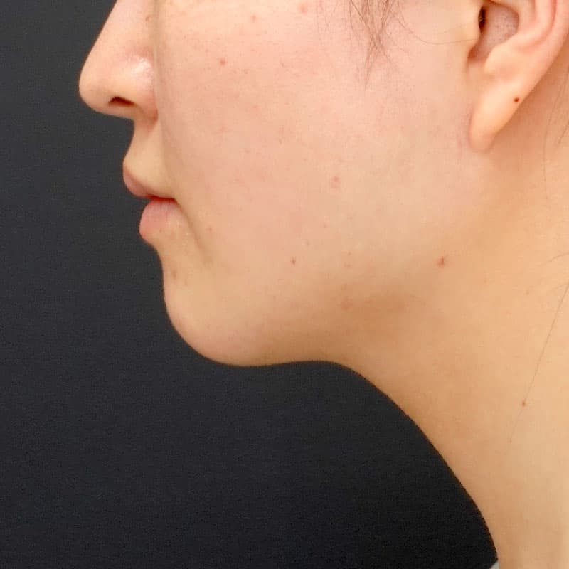 20260817_N152889_nishikawa_face-liposuction_masseter-muscle-botox①After