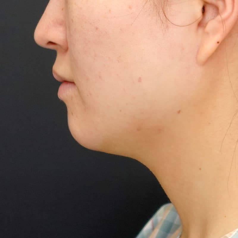 20260817_N152889_nishikawa_face-liposuction_masseter-muscle-botox①Before