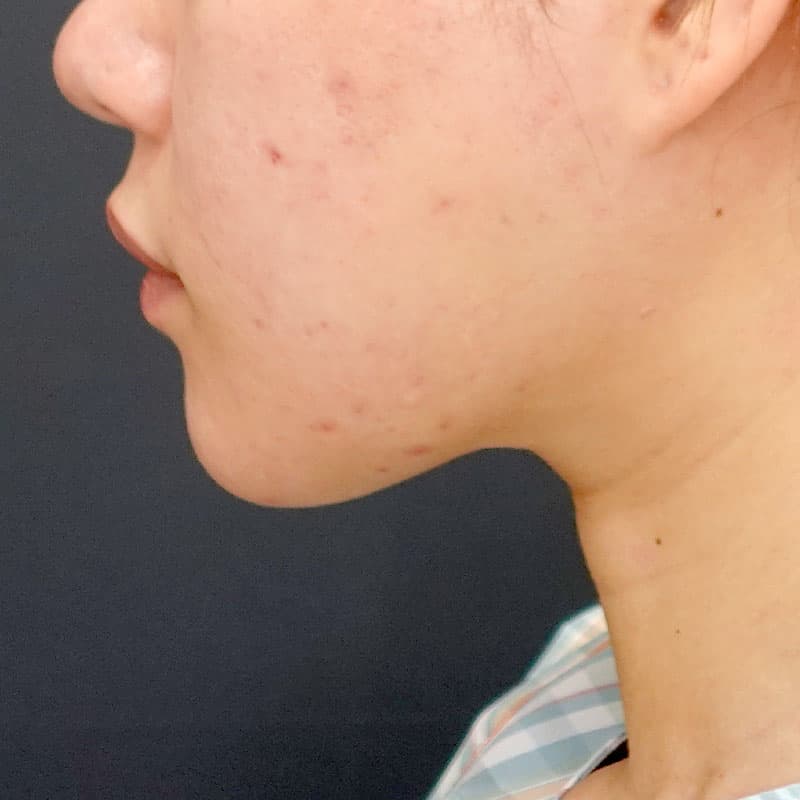 20260817_N154380_nishikawa_face-liposuction_masseter-muscle-botox①After