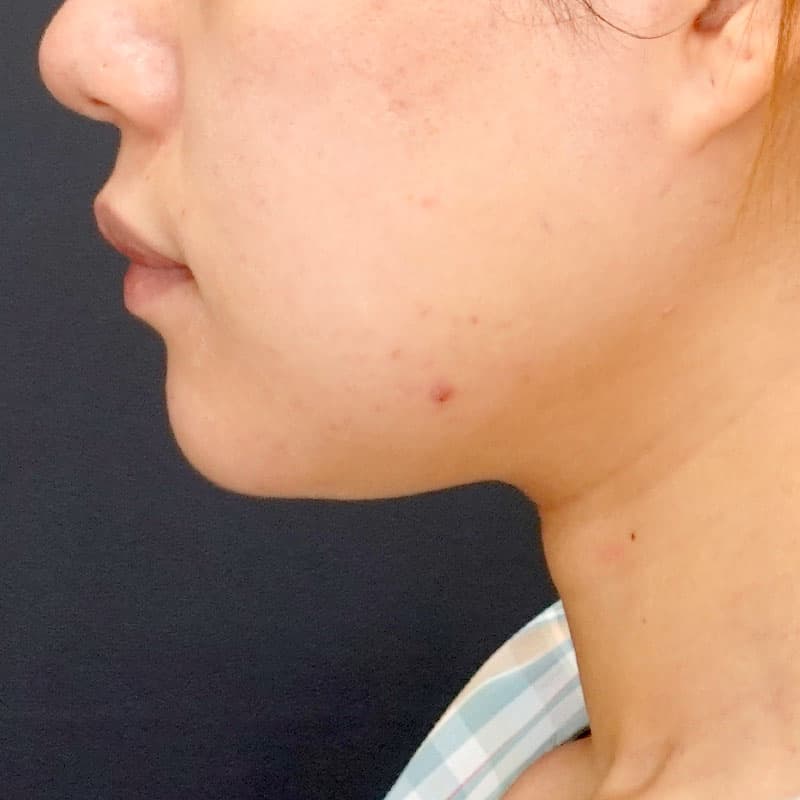20260817_N154380_nishikawa_face-liposuction_masseter-muscle-botox①Before
