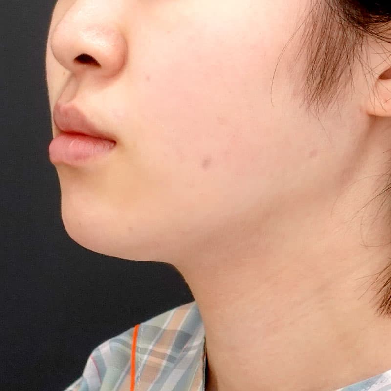 20260817_N171128_nishikawa_face-liposuction_masseter-muscle-botox①After