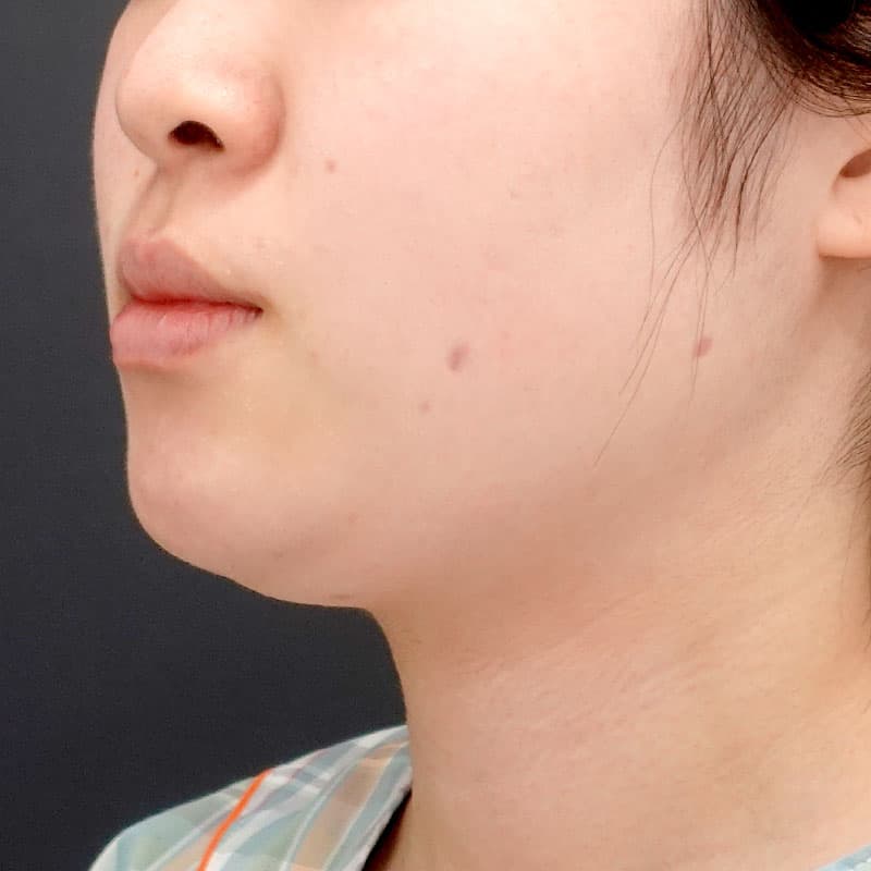 20260817_N171128_nishikawa_face-liposuction_masseter-muscle-botox①Before