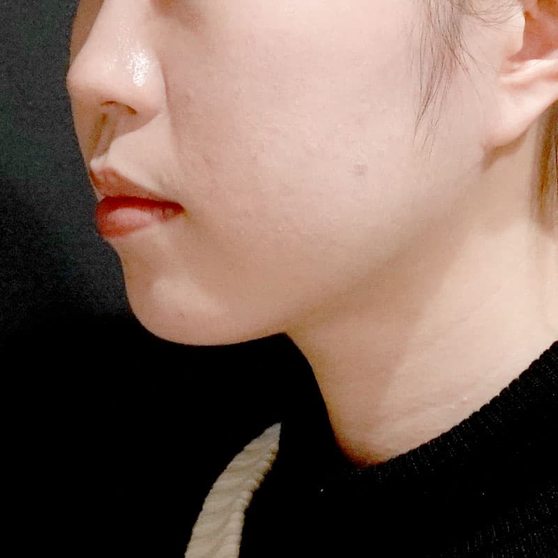 20260820_S18431_suzuki_face-liposuction_masseter-muscle-botox①After
