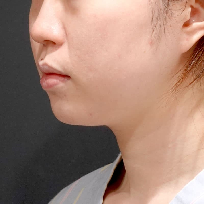 20260820_S18431_suzuki_face-liposuction_masseter-muscle-botox①Before