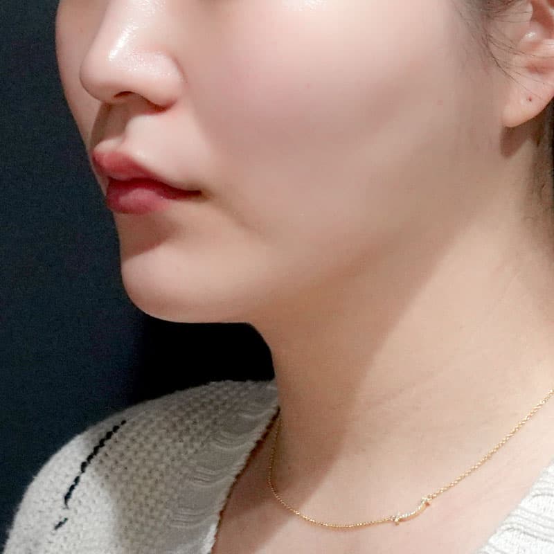 20260820_S23904_suzuki_face-liposuction_masseter-muscle-botox①After