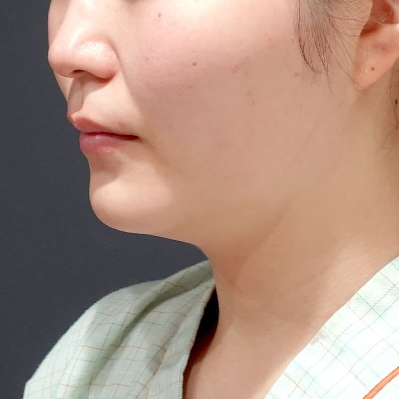 20260820_S23904_suzuki_face-liposuction_masseter-muscle-botox①Before
