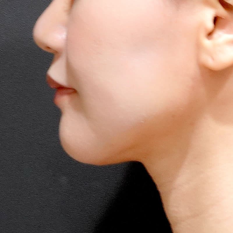 20260820_S24692_suzuki_face-liposuction_masseter-muscle-botox①After