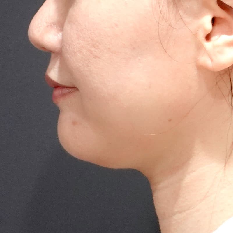 20260820_S24692_suzuki_face-liposuction_masseter-muscle-botox①Before