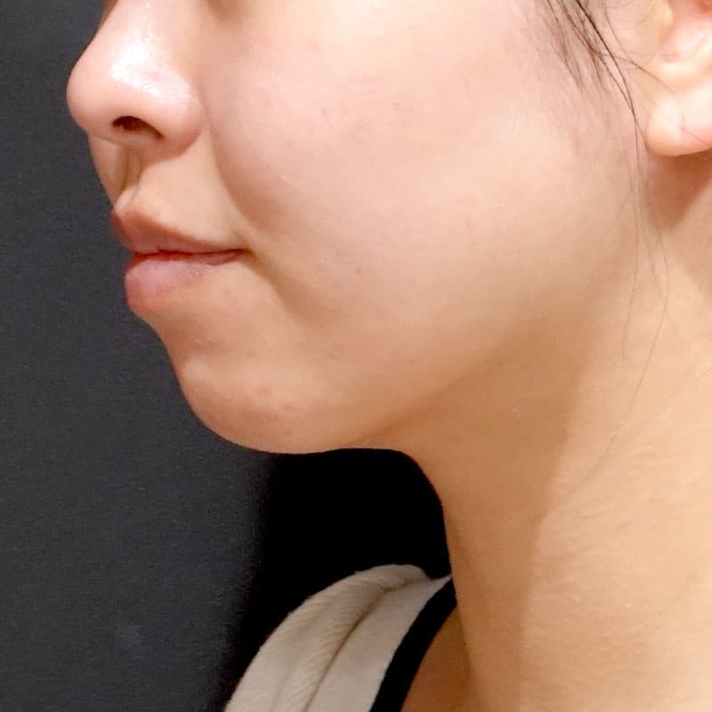 20260820_S24904_suzuki_face-liposuction_masseter-muscle-botox①After