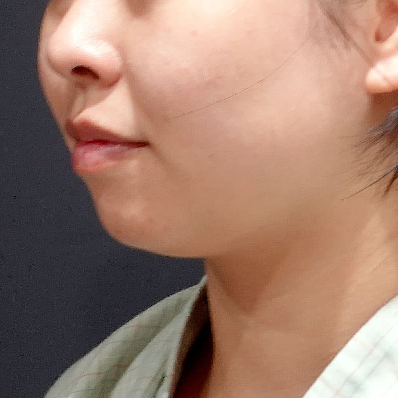 20260820_S24904_suzuki_face-liposuction_masseter-muscle-botox①Before