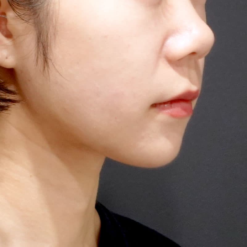 20260820_S24981_suzuki_face-liposuction_masseter-muscle-botox①After