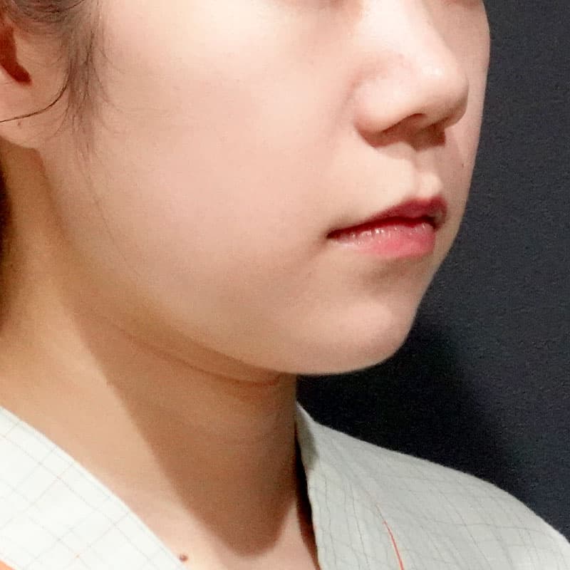 20260820_S24981_suzuki_face-liposuction_masseter-muscle-botox①Before