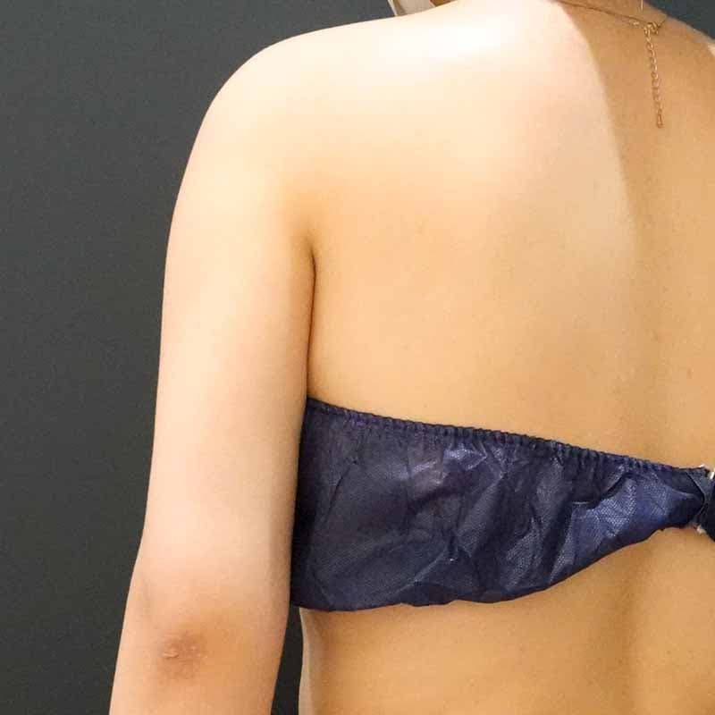 20260821_G41306_takemura_arm-liposuction①After