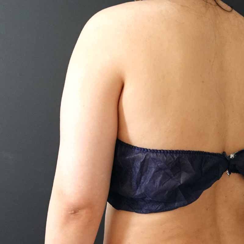 20260821_G41306_takemura_arm-liposuction①Before