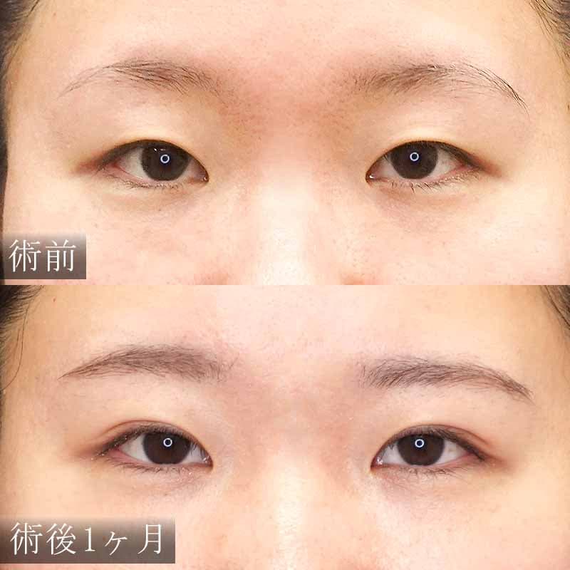 自然癒着法 症例