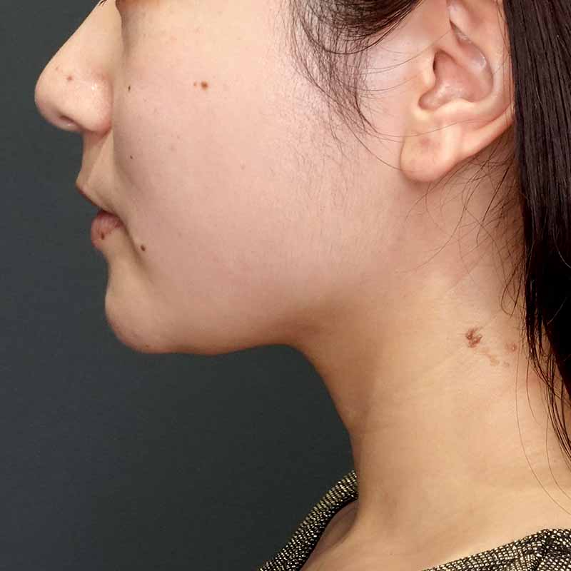 20260905_G101758_ishihara_face-liposuction_philtrum-botox①After