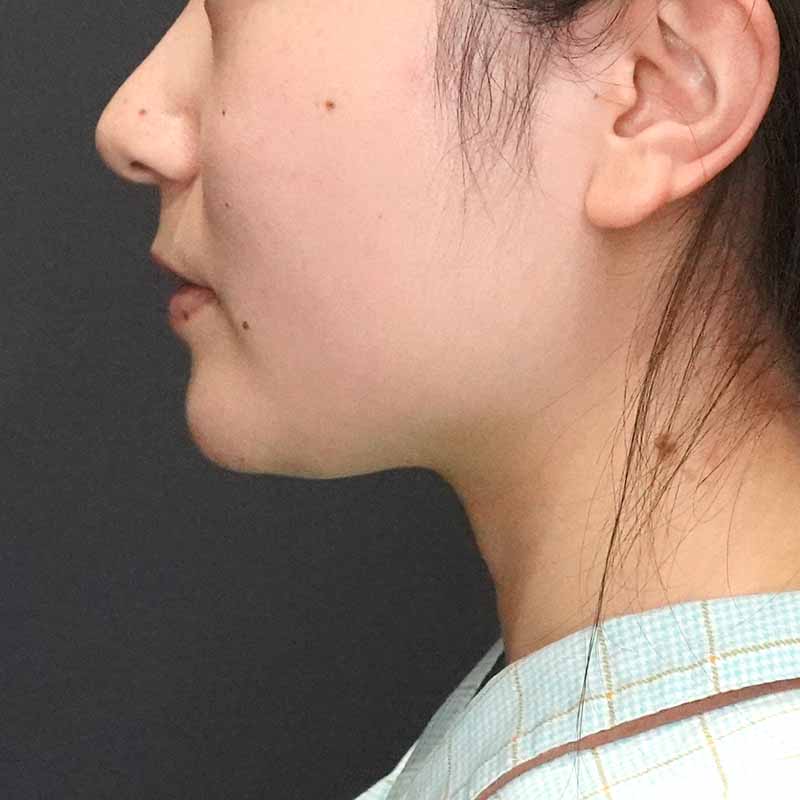 20260905_G101758_ishihara_face-liposuction_philtrum-botox①Before