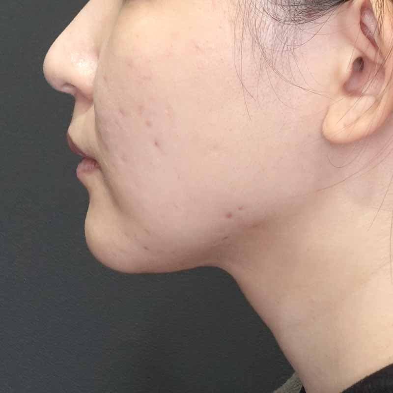 20260905_G41279_ishihara_face-liposuction_philtrum-botox②After