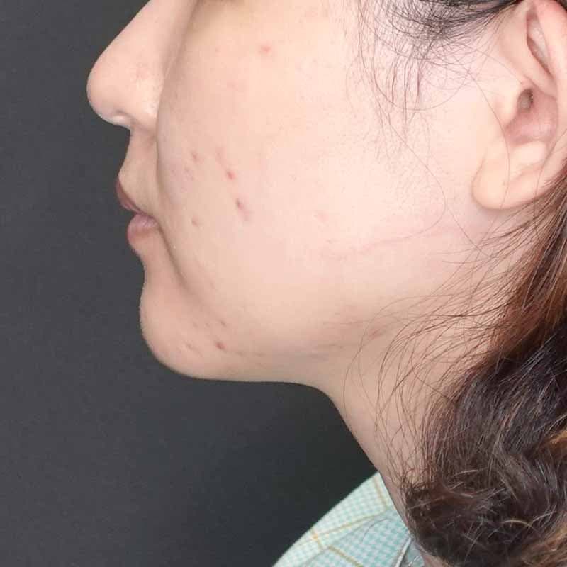 20260905_G41279_ishihara_face-liposuction_philtrum-botox②Before
