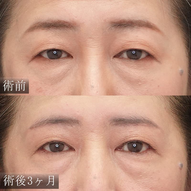 眉下切開 症例1