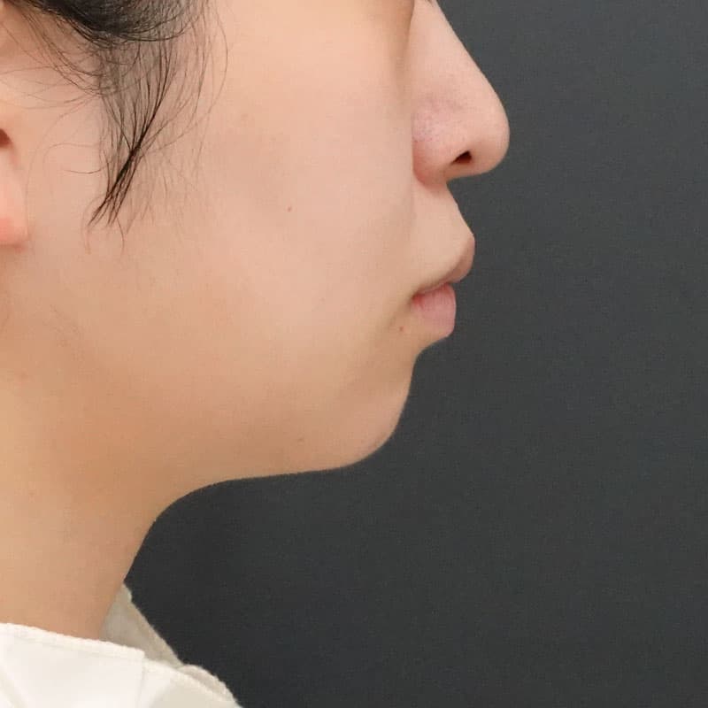 20260926_F180749_kadoya_face-liposuction①After