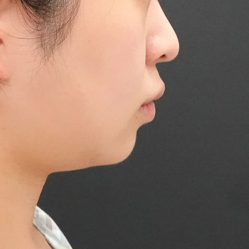 20260926_F180749_kadoya_face-liposuction①Before