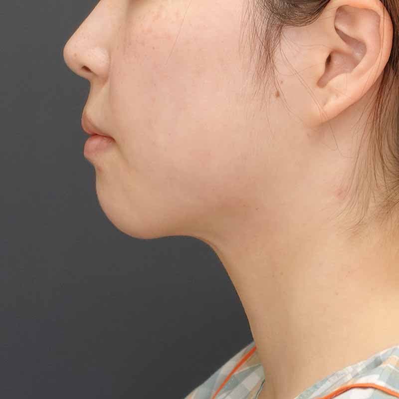 20260929_N156346_morishima_face-liposuction_philtrum-botox①After