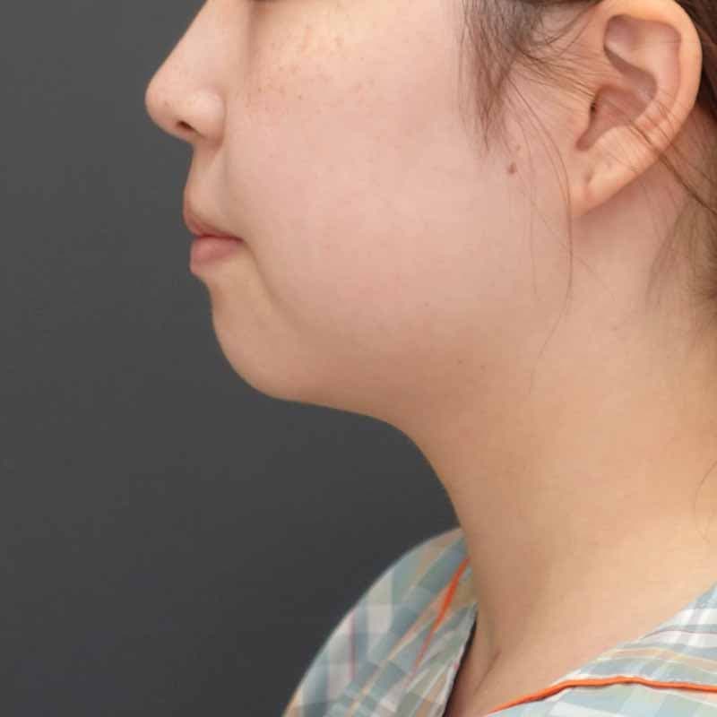 20260929_N156346_morishima_face-liposuction_philtrum-botox①Before