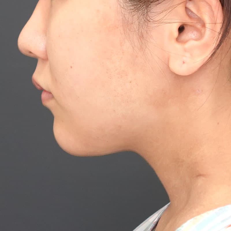 20260929_N15990_morishima_face-liposuction_philtrum-botox①After