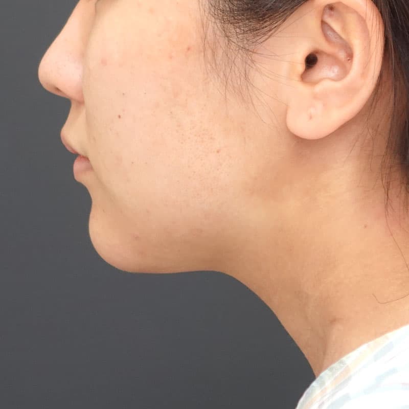 20260929_N15990_morishima_face-liposuction_philtrum-botox①Before