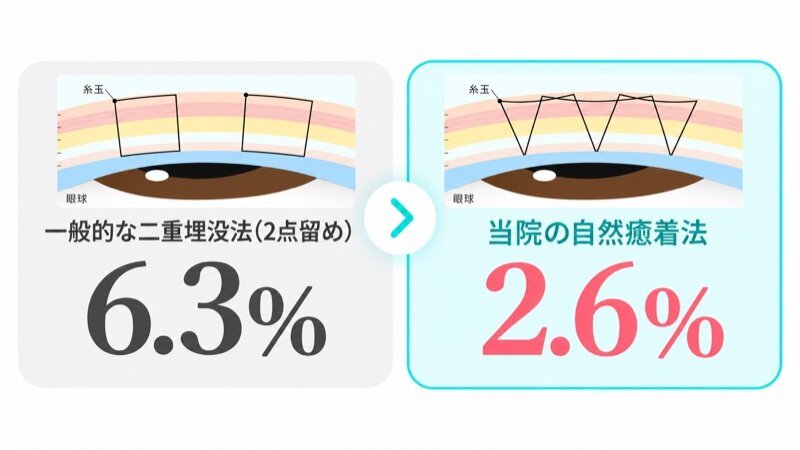 二重ラインの消失率の比較：一般的な二重埋没法(2点留め)6.3％／当院の自然癒着法2.6％