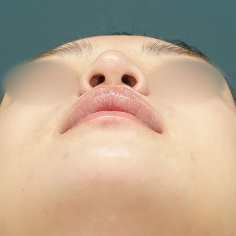20261006_N165092_morishima_nostril reduction ①After